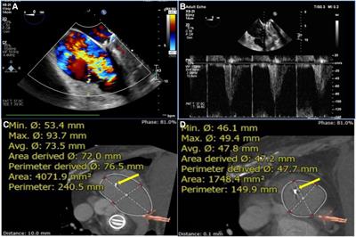 Treatment of severe tricuspid regurgitation induced by permanent pacemaker lead: Transcatheter tricuspid valve replacement with the guidance of 3-dimensional printing